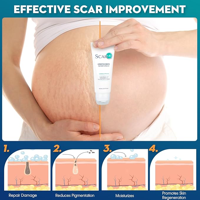 Stretch Mark Repair Cream is Formulated with Botanical Ingredients to Effectively Minimize Stretch Marks for a Smoother, More Even Skin Tone