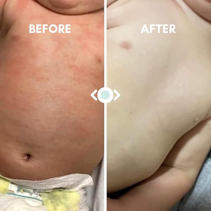 Irene Organics Baby Eczema Relief Balm, Healing Ointment Baby Moisturizing Cream for Eczema, Dry, Itchy Skin. Award Winning Baby Skincare for Sensitive Skin, Safe for Newborns, Kids and Adults