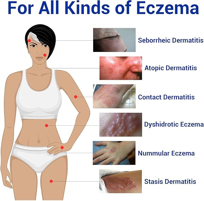Eczema Cream for Dry, Itchy, Irritated, and Eczema Prone Skin, Maximum Strength Treatment Ointment for Rash, Psoriasis, Dermatitis(7.05oz)