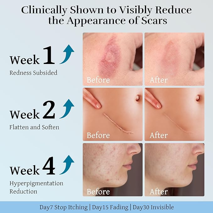 Advanced Scar Cream, Scar Reduction Treatment for Improves Skin Texture & Helps Remove Acne, Stretch Marks, Surgery, C Section, Burn, Keloid & Hypertrophic Scars 1.76 Oz (50g)