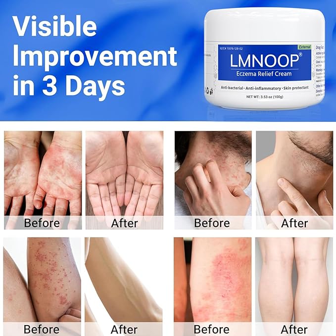 Eczema Cream for Dry, Itchy, Irritated, and Eczema Prone Skin, Maximum Strength Treatment Ointment for Rash, Psoriasis, Dermatitis 3.53oz