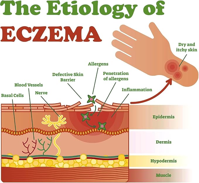 Eczema Cream for Dry, Itchy, Irritated, and Eczema Prone Skin, Maximum Strength Treatment Ointment for Rash, Psoriasis, Dermatitis (Contains Menthol) 3.53oz