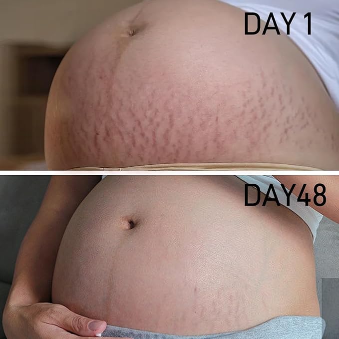 Stretch Mark Cream for Pregnancy - Deep Repair & Prevention for Stretch Marks - Stretch Mark Oil/Lotion for Women - Prenatal & Postnatal Skin Care (2Pack)