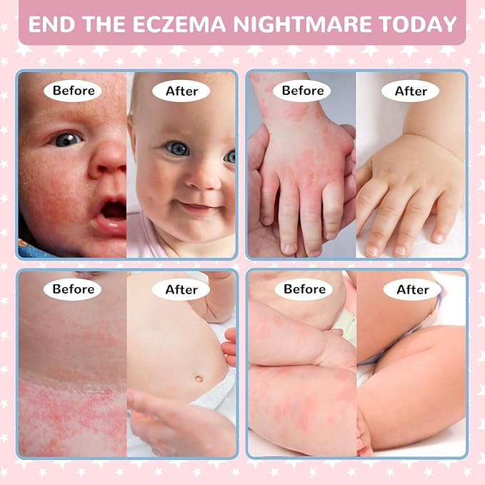 Baby Eczema Relief Cream, All-Natural Herbal Formula for Safe, Soothing Skin Protection Against Rashes, Dryness, Redness, and Itchiness, 3.53oz