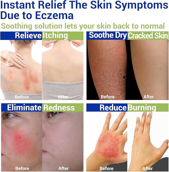 Eczema Cream for Dry, Itchy, Irritated, and Eczema Prone Skin, Maximum Strength Treatment Ointment for Rash, Psoriasis, Dermatitis(7.05oz)