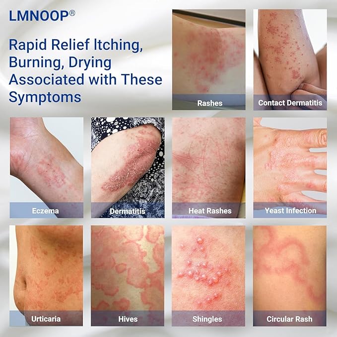 Eczema Cream for Dry, Itchy, Irritated, and Eczema Prone Skin, Maximum Strength Treatment Ointment for Rash, Psoriasis, Dermatitis 3.53oz