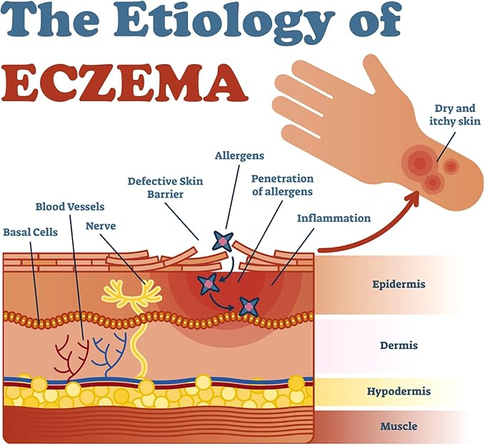 Eczema Cream for Dry, Itchy, Irritated, and Eczema Prone Skin, Maximum Strength Treatment Ointment for Rash, Psoriasis, Dermatitis 3.53oz