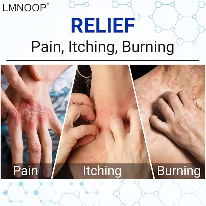 Eczema Cream, Maximum Strength Treatment Ointment for Rash, Psoriasis, Dermatitis, Urticaria, Jock Itch, Fungal Infection, Anti-Itch, Relief for Sensitive, Irritated Skin 1.76oz