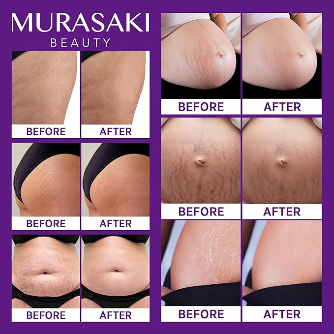 Stretch Mark Cream Prevention for Pregnancy - Maternity Cream for Stretch Marks Removal | Nourishing Formula – Prevents Stretch Marks & Improves Elasticity - 4 oz (120g) (2 Pack)